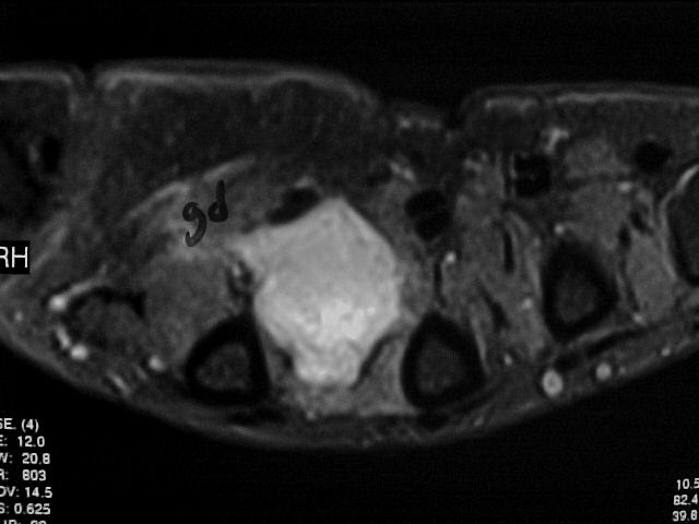 Figure 6 for case Glomus tumors